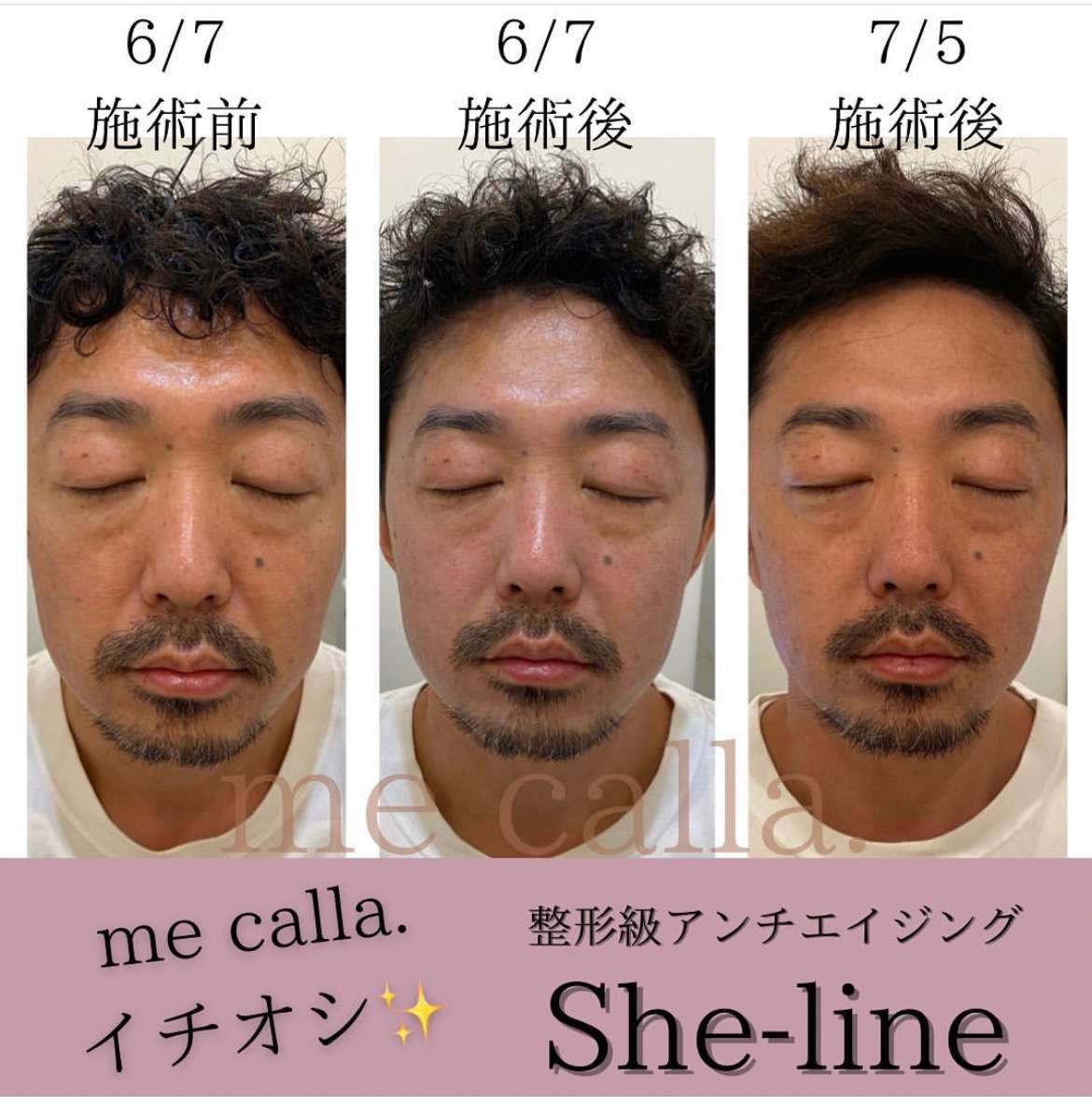 メンズハイフ】必見！驚きの若返りビフォーアフター▶︎▶︎She-lineで