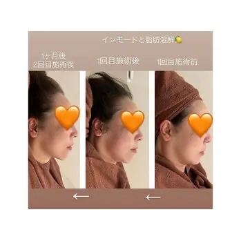 【柏市】圧倒的小顔効果★インモード＆脂肪溶解セット整形級BA💆‍♀️