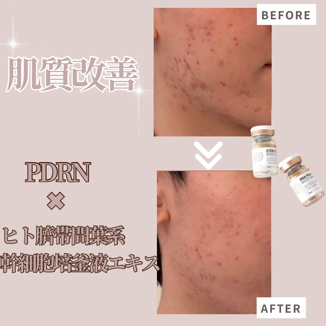 【柏市】プラズマ×リジュラン💉×LDM/根本から肌質改善/毛穴・ニキビ跡/肌再生🫶