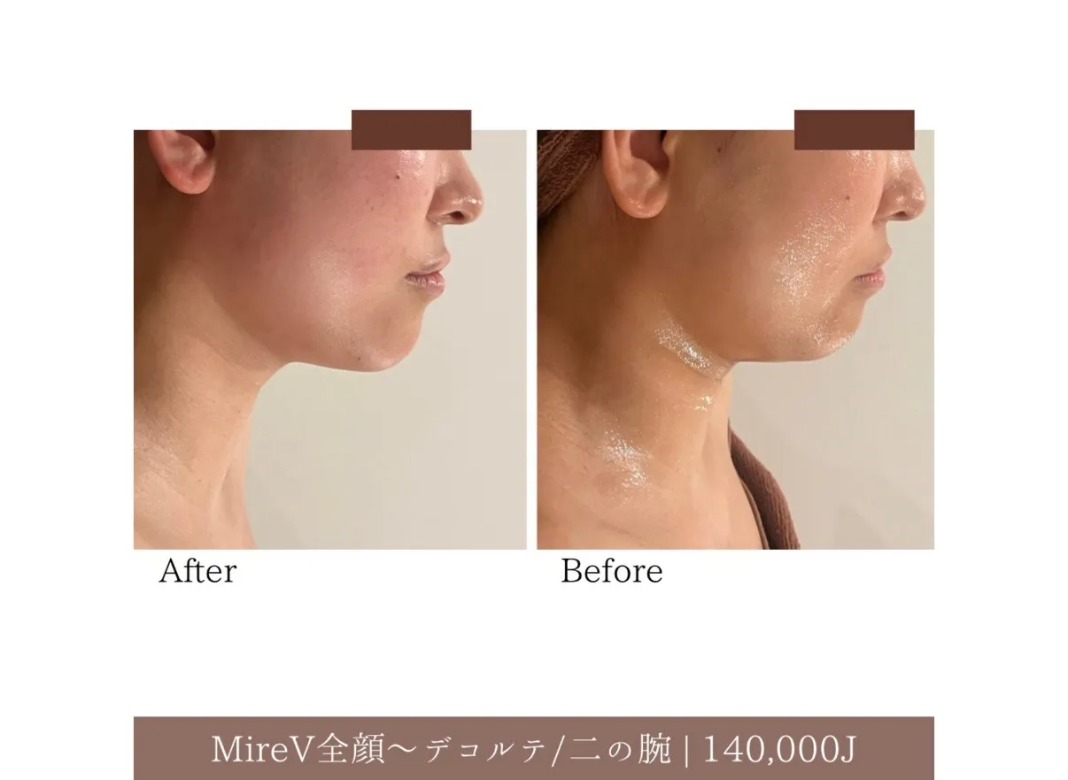 【柏駅】マイクロ波MlireV💆♀️小顔リフト頬~顎下初回BA/#オンダ🔥