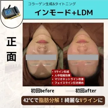 【柏駅】インモード✨42℃で脂肪分解/レモンボトル併用🍍◎