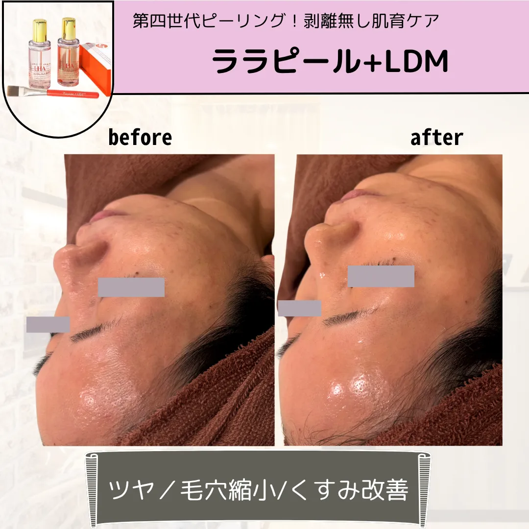 【柏市】初回限定🌿毛穴洗浄×ララピール×プラズマ×LDM✨