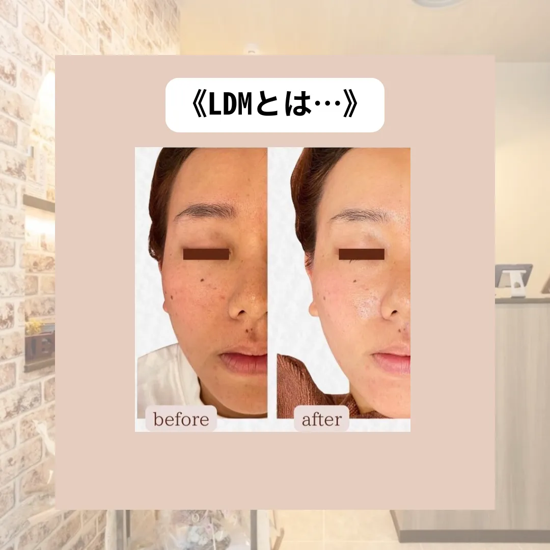 【柏市】美容皮膚科でも人気!話題のLDMとは…?乾燥肌.鎮静🙆♀️✨