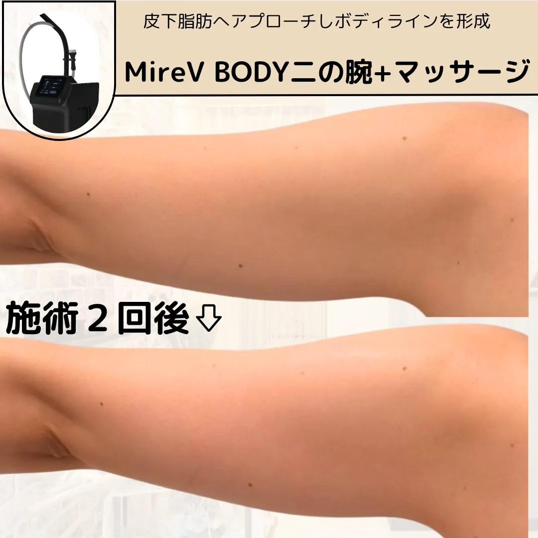 【柏市】たった2回で二の腕幅が変わる🤝マイクロ波MireV BODY❤️🔥