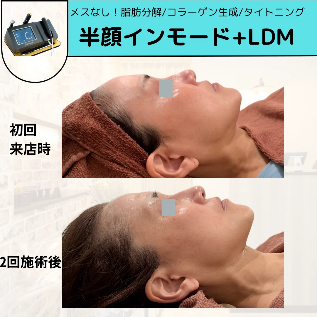 【柏市】脂肪タイプではなく、たるみ.もたつきタイプの方💆‍♀️♡
