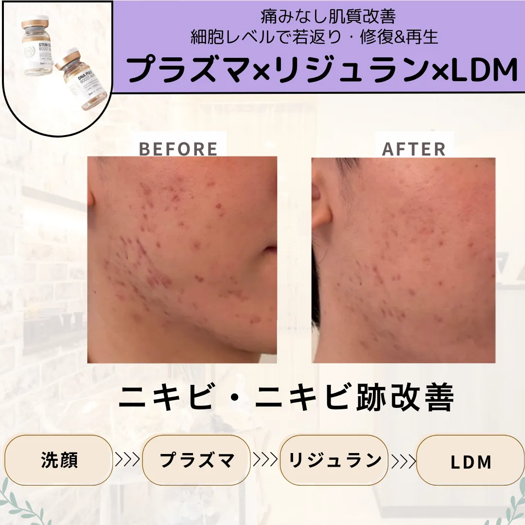 【柏市】ニキビ肌荒れ改善😌2週間に１回のご来店🙆‍♀️リジュラン