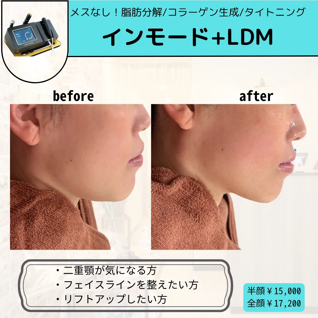 【柏市】中顔面短縮インモード×LDM🪄小顔ケア・肌質改善同日🙆‍♂️