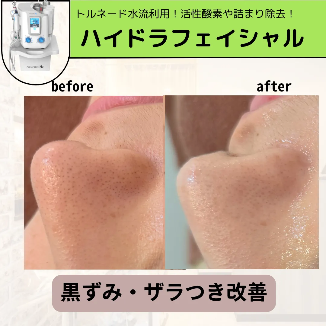 【柏駅】毛穴洗浄で黒ずみ.悪玉菌除去💧美容液が染み込む肌へ✨!
