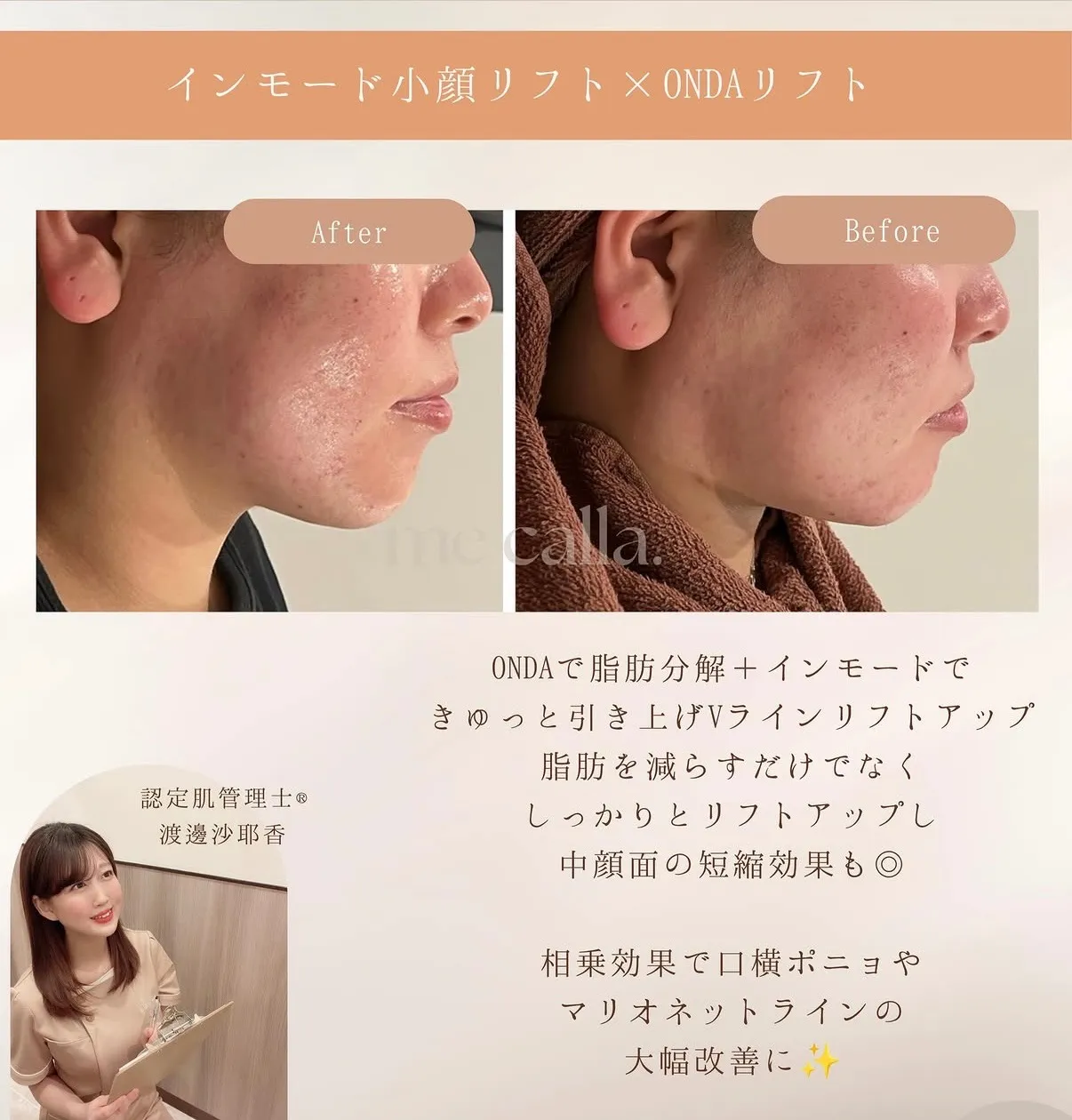 【柏市】インモード×ONDA×LDMで叶える理想な小顔へ🌿
