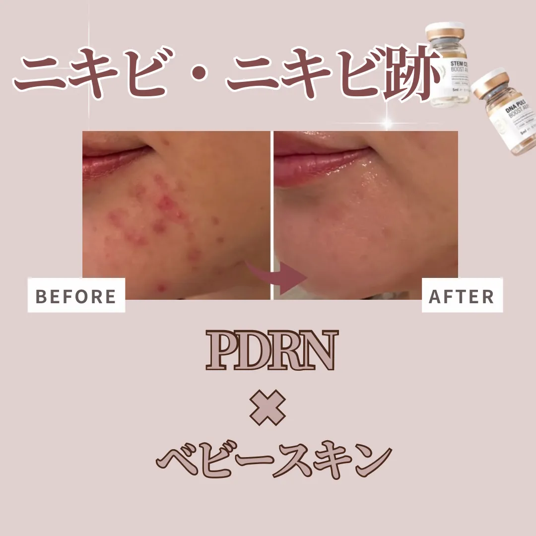 【柏市】肌質改善✨プラズマ×高濃度アンプル×LDM☺️ニキビ肌◎