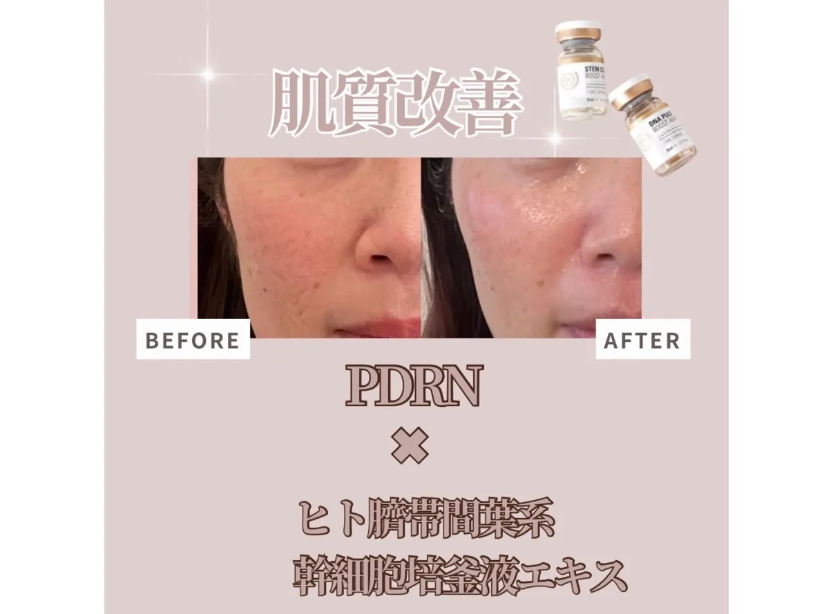 【柏駅】リジュラン×プラズマ×LDM/毛穴/キメ/くすみ改善👼🫧