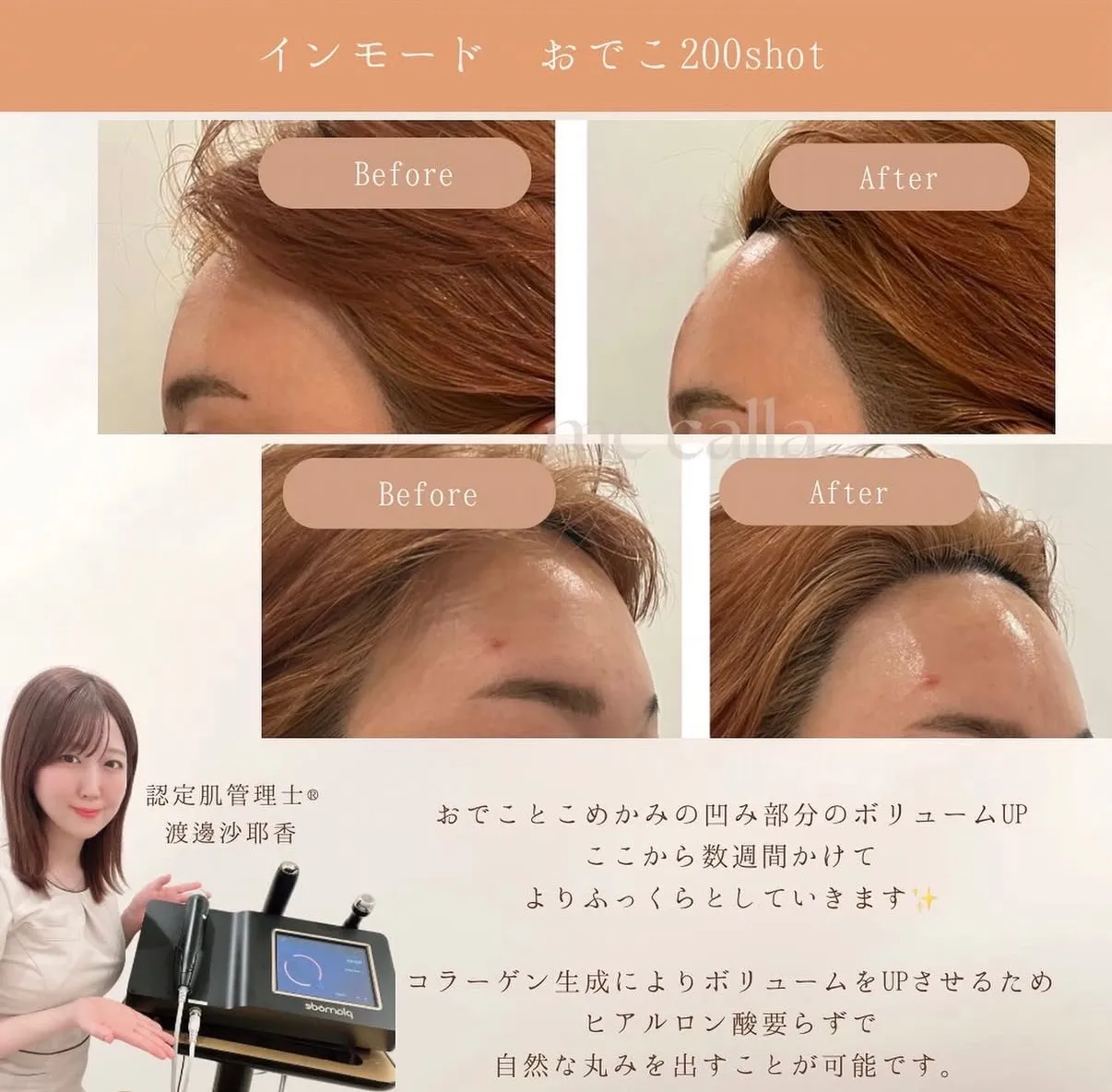 【柏市】おでこの丸みは作れる💪こめかみ・凹みボリュームUP👩