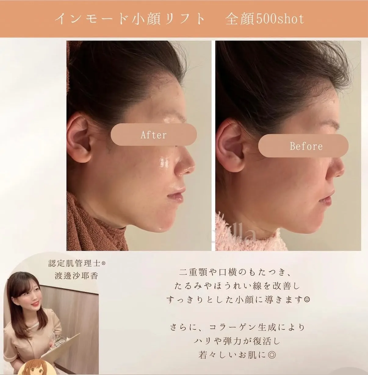 【柏駅】インモード+水玉💕すっきりフェイスライン/鎮静ハリ肌☺️