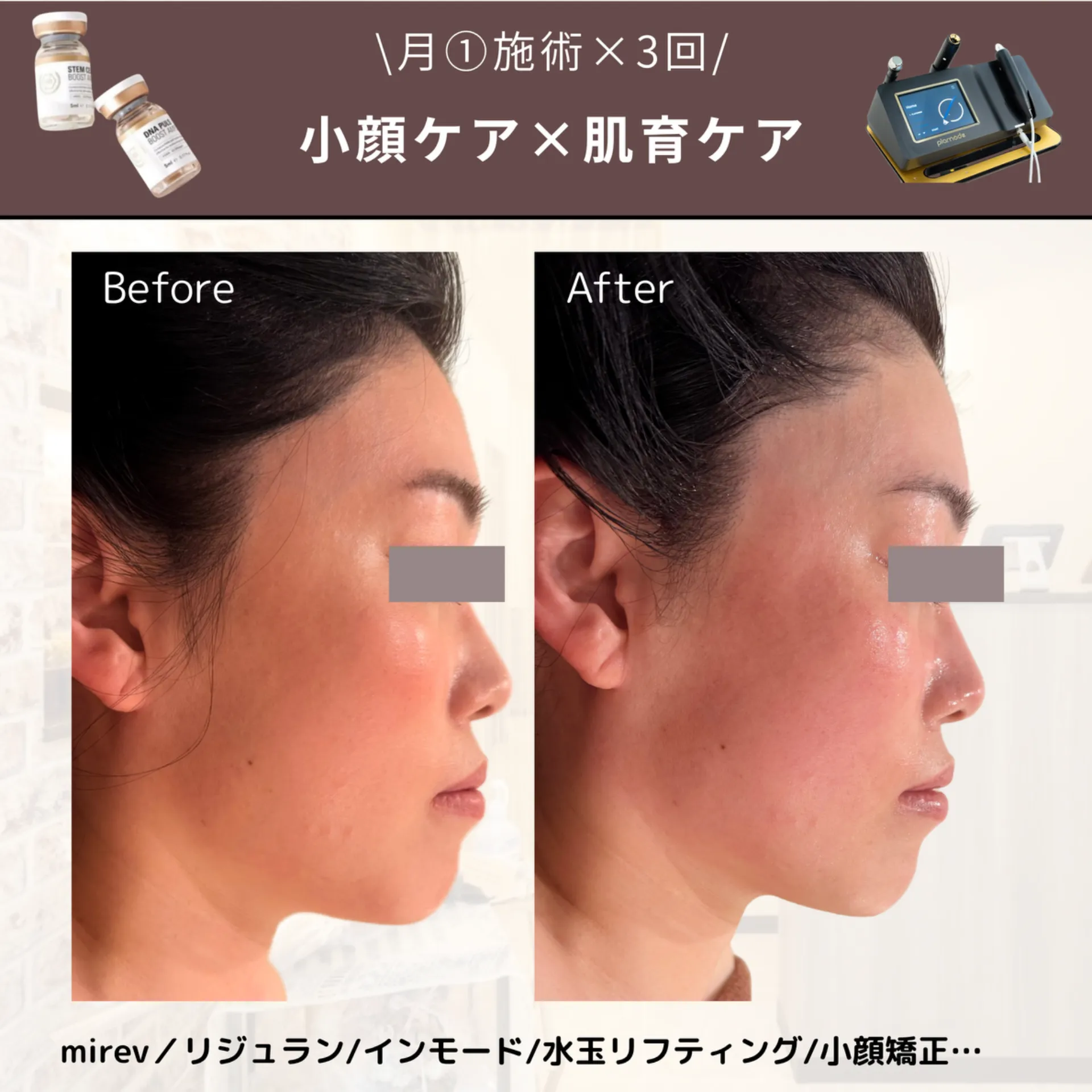 【柏市】小顔×肌質改善を同時に叶える✨毛穴/リフトアップ