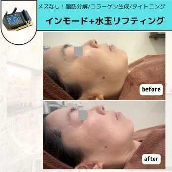 【柏市】インモード/口横ポニョ改善/コラーゲン生成/脂肪分解👏