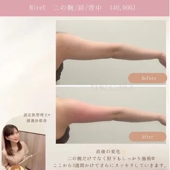 【柏市】mirev二の腕💪華奢BODY/脂肪分解/ダウンタイムなし🙆‍♀️