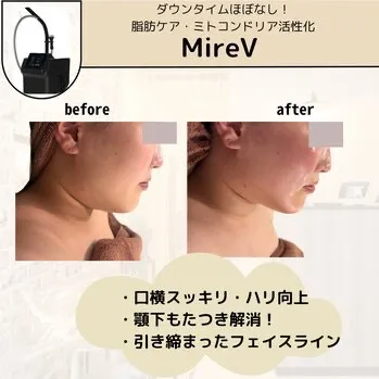 【柏駅】MireV(ONDA)で理想のフェイスライン☺️脂肪分解/ハリ⤴️