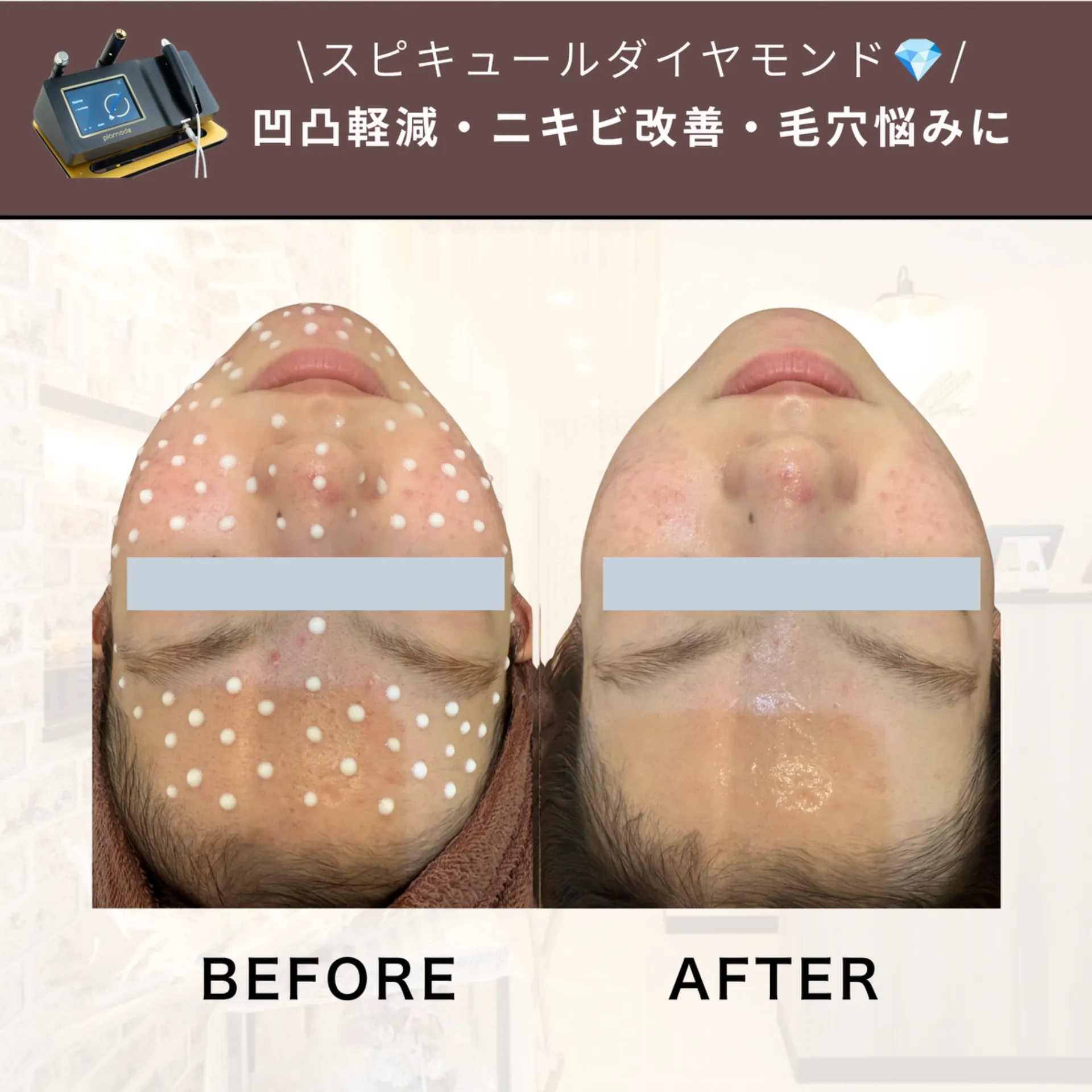 【柏駅】スピキュールダイヤモンド💎ニキビ・毛穴お悩みに◎